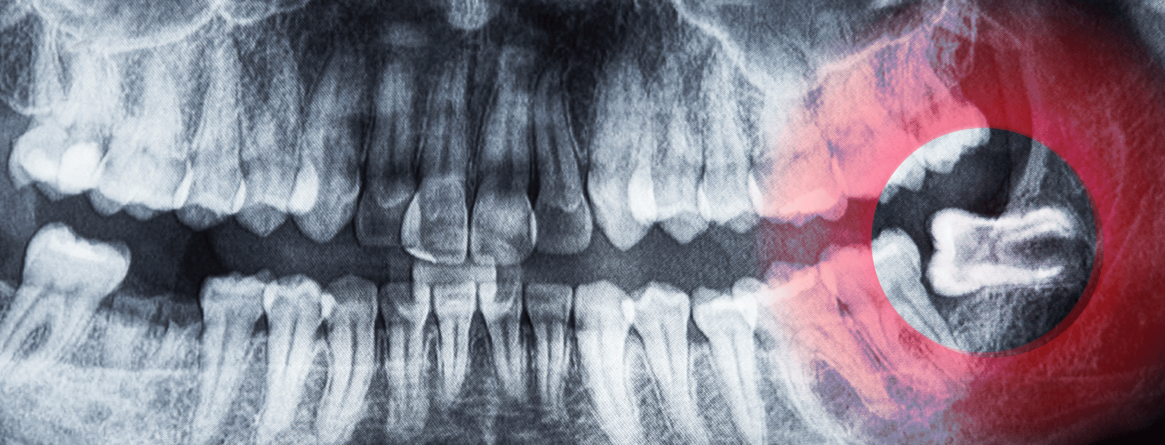 X-Ray of wisdom teeth