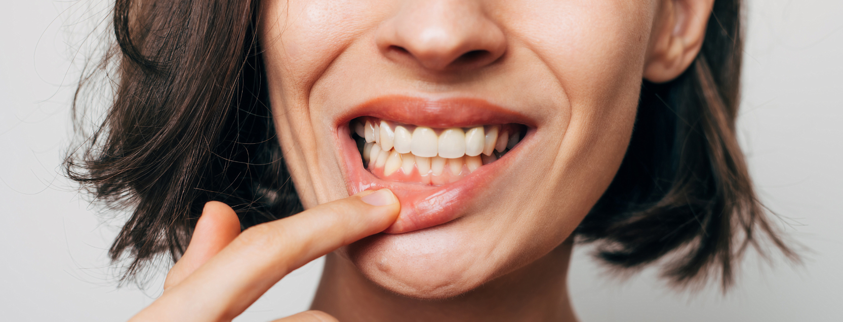 women smiling and pointing at her gums